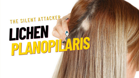 The Silent Attacker: Lichen Planopilaris and Hair Loss