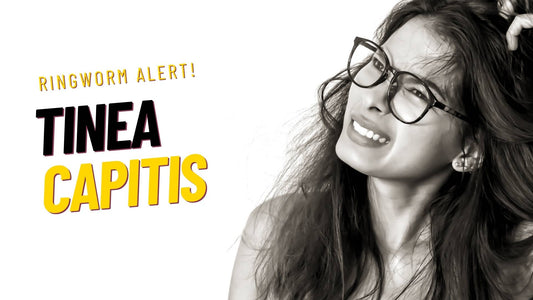 tinea capitis ringworm and hair loss