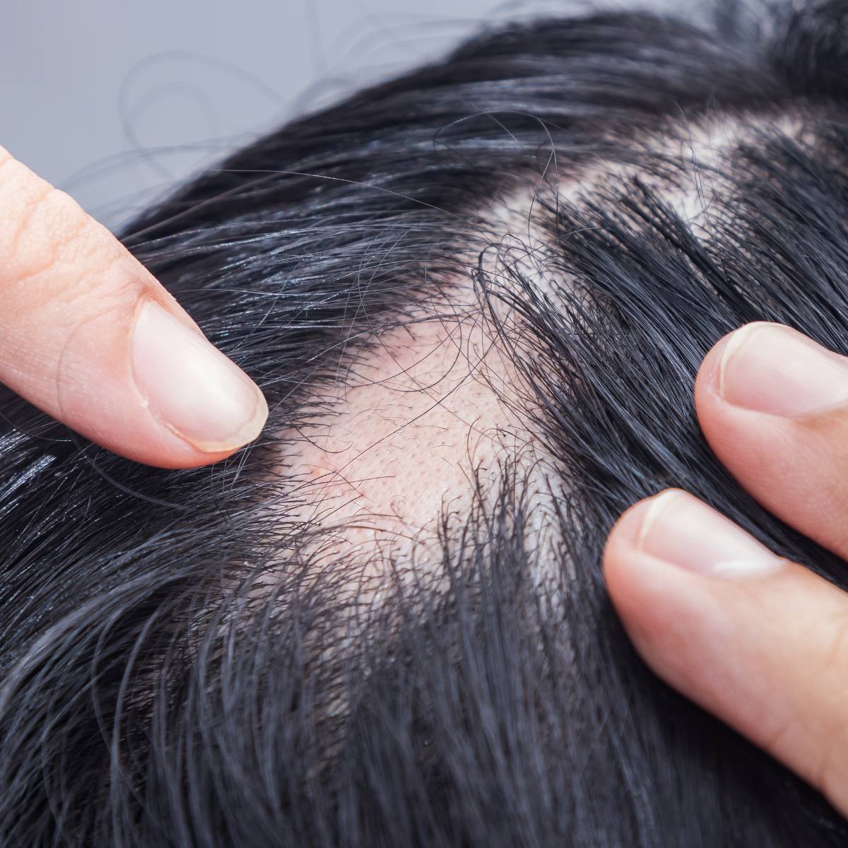 Cicatricial Alopecia: Strategies for Managing Scarring Hair Loss