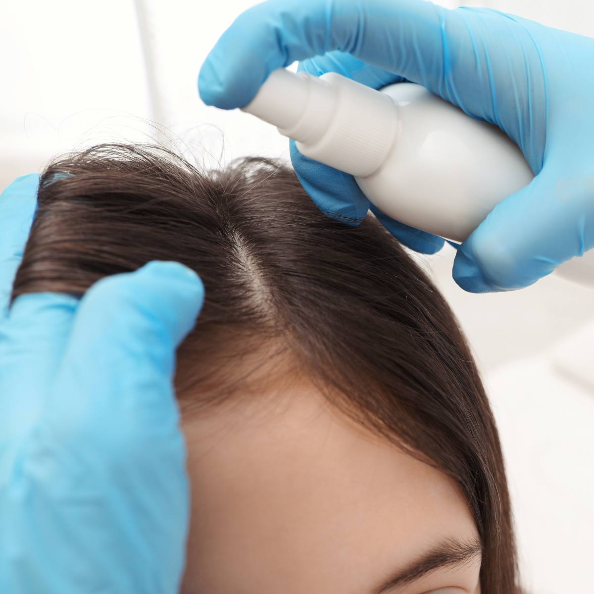 Telogen Effluvium hair loss