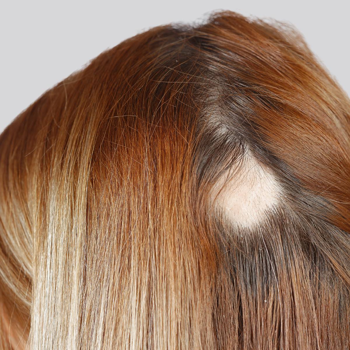 Telogen Effluvium hair loss
